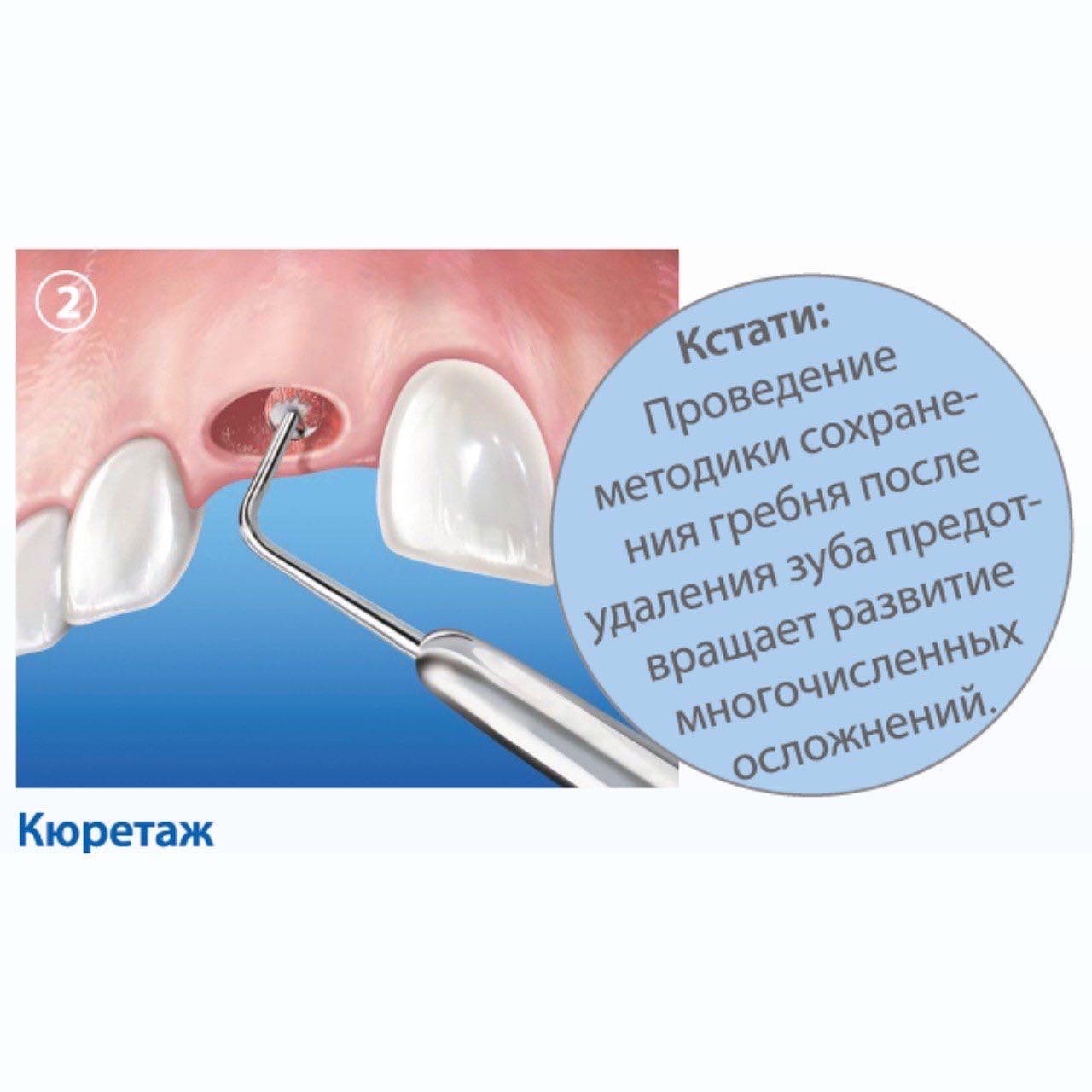 Методика сохранения альвеолярного гребня